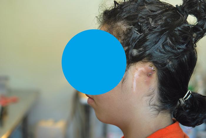 Microtia bilateral